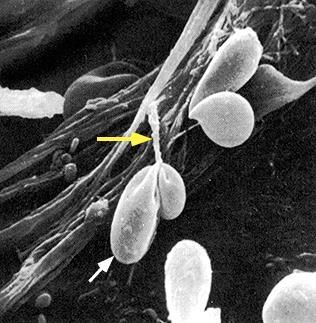 Preeclampsia Marsch (menetelési) hemoglobinuria Infekció Malária Clostridium