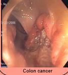 Fokozott/krónikus vérvesztés - Gastrointestinalis vérzés (pepticus fekély, gastritis, hiatus hernia, diverticulosis,