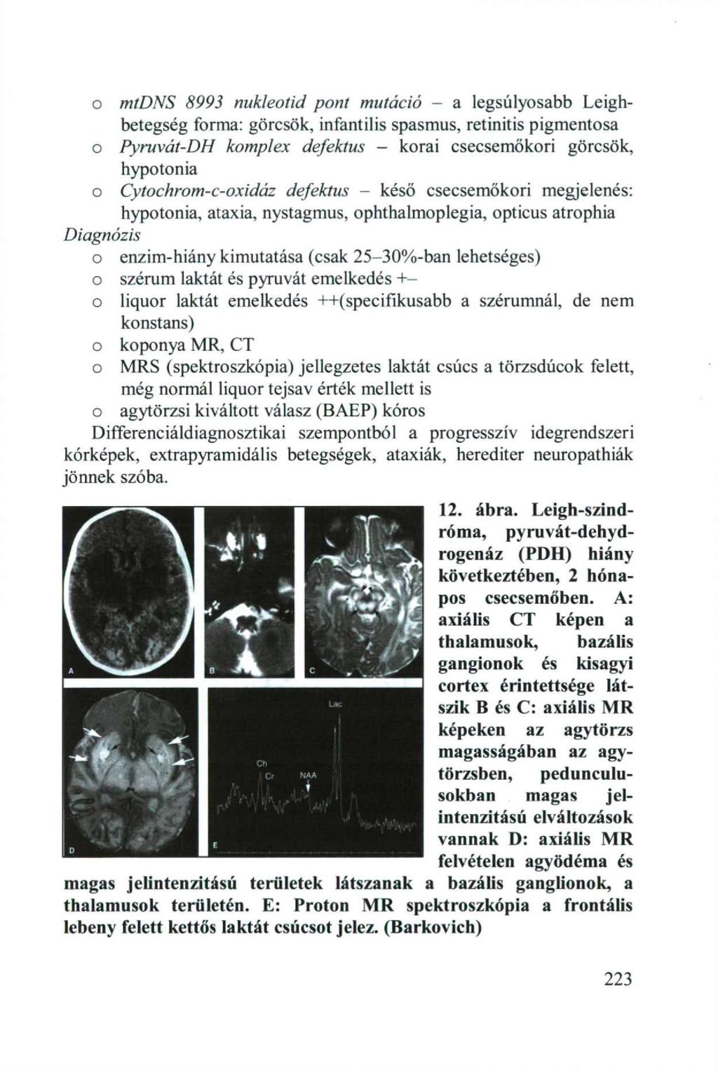 o mtdns 8993 nukleotid pont mutáció - a legsúlyosabb Leighbetegség forma: görcsök, infantilis spasmus, retinitis pigmentosa o Pyruvát-DH komplex defektus - korai csecsemőkori görcsök, hypotonia o