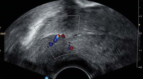 Prostate gland calcification treatment Свежие записи