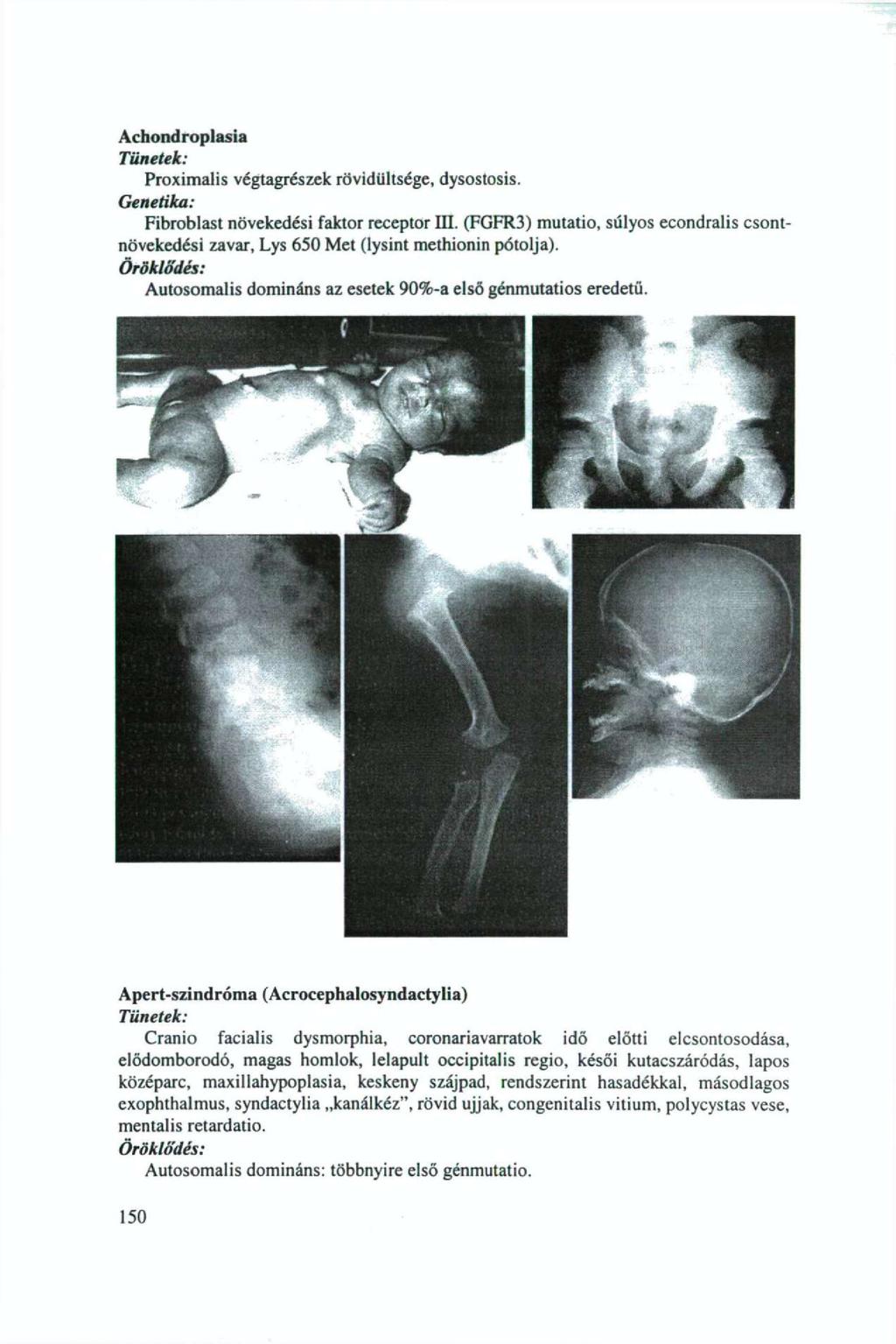 Achondroplasia Tünetek: Proximalis végtagrészek rövidíiltsége, dysostosis. Genetika: Fibroblast növekedési faktor receptor III.