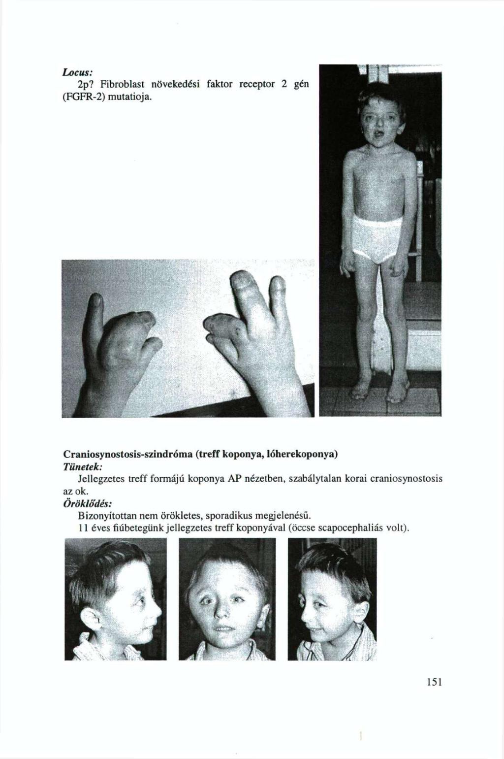 Craniosynostosis-szindróma (treff koponya, lőherekoponya) Tünetek: Jellegzetes treff formájú koponya AP nézetben, szabálytalan korai craniosynostosis