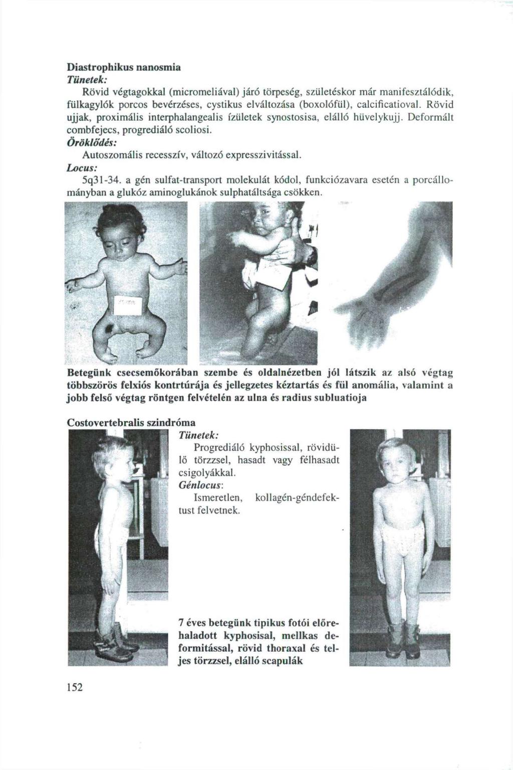 Diastrophikus nanosmia Tünetek: Rövid végtagokkal (micromeliával) járó törpeség, születéskor már manifesztálódik, fülkagylók porcos bevérzéses, cystikus elváltozása (boxolófül), calcificatioval.