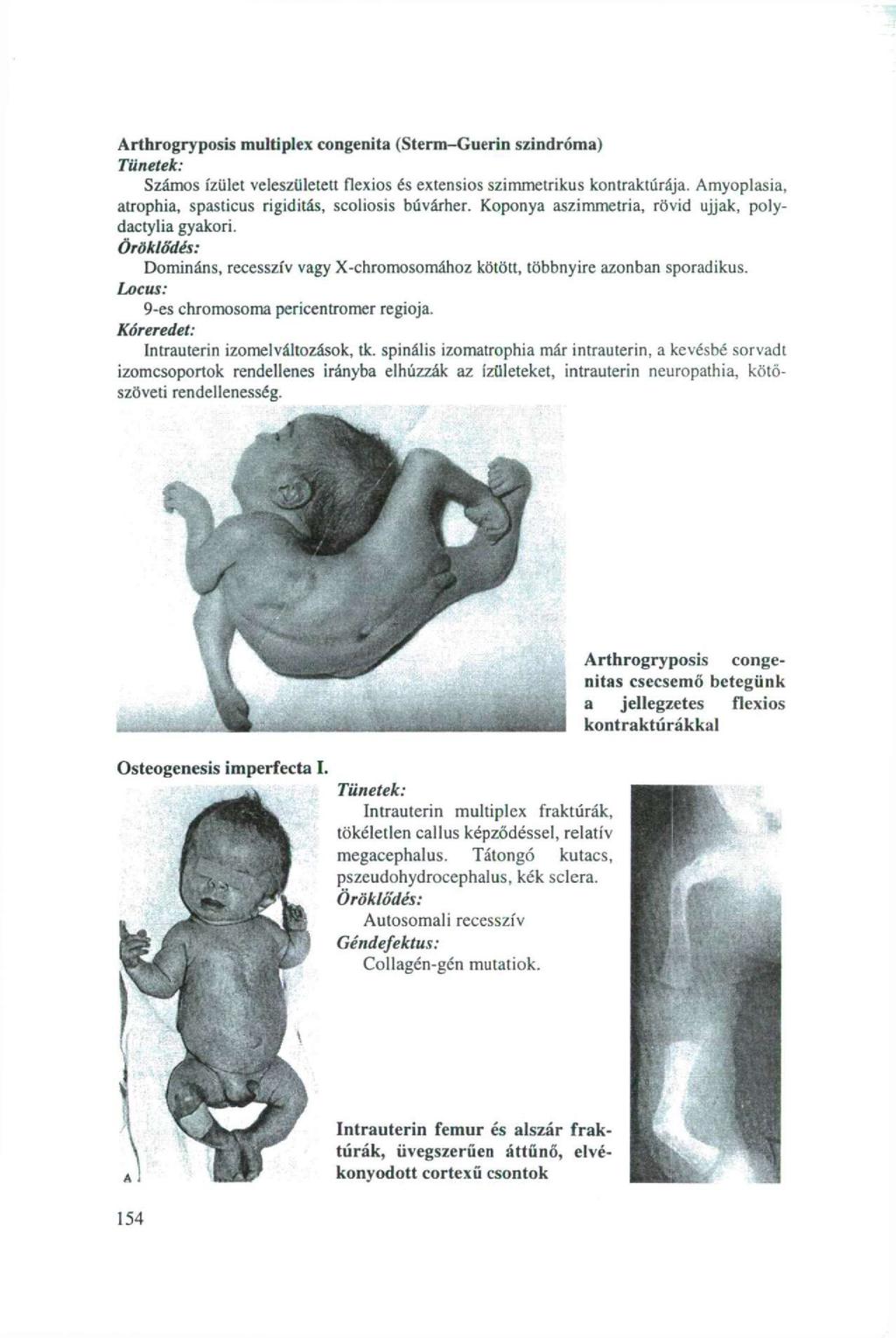 Arthrogryposis multiplex congenita (Sterm-Guerin szindróma) Tünetek; Számos ízület veleszületett flexios és extensios szimmetrikus kontraktúrája.