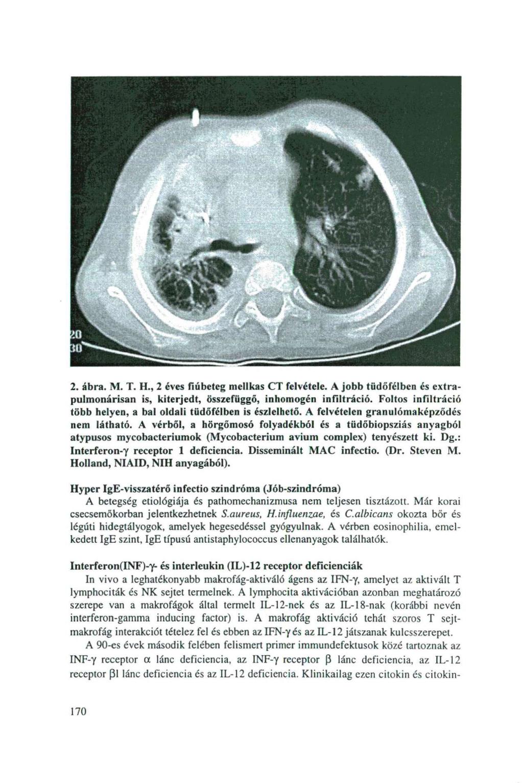 2. ábra. M. T. H., 2 éves fiúbeteg mellkas CT felvétele. A jobb tüdőfélben és extrapulmonárisan is, kiterjedt, összefüggő, inhomogén infiltráció.