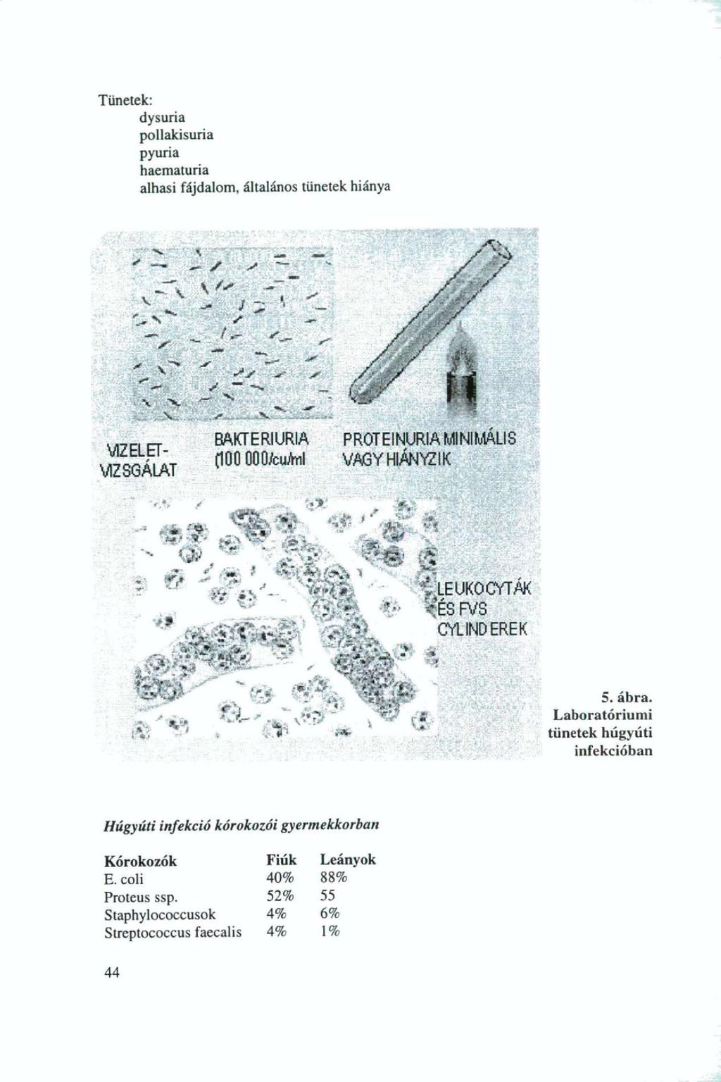 Tünetek: dysuria pollakisuria pyuria haematuria alhasi fájdalom, általános tünetek hiánya - in Ii fflp -r - - VIZELET- VIZSGÁLAT - BAKTERI URIA PROTEINURIA MINIMÁLIS (100 000/cuAnl VAGY HIÁNYZIK M