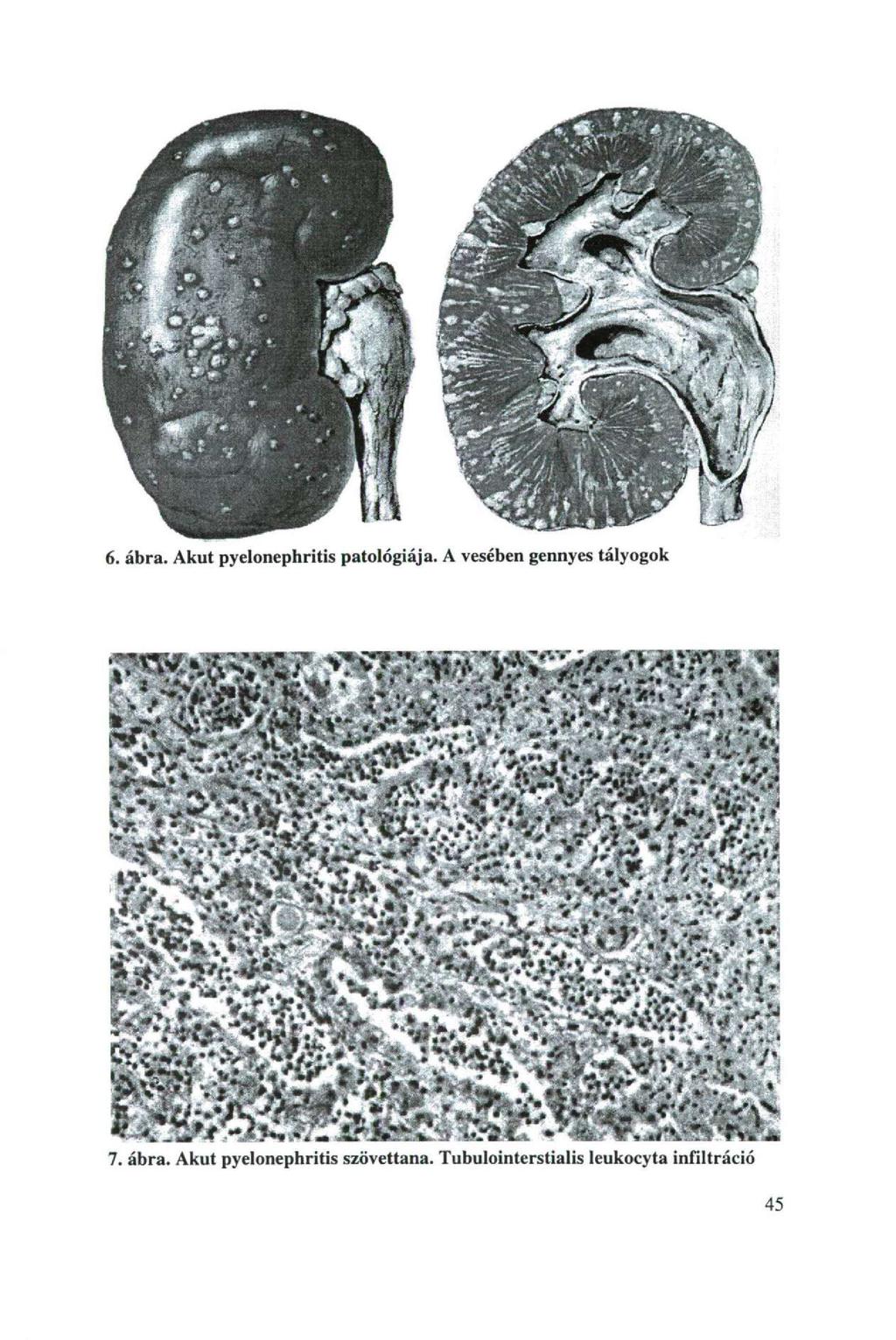 6. ábra. Akut pyelonephritis patológiája. A vesében gennyes tályogok 7. ábra. Akut pyelonephritis szövettana.