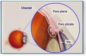 Intermedier uveitis Fuchs 1908: cyclitis chronica 8% az összes uveitisnek 10-15% sclerosis multiplex Pars planitis Gyulladás elsődleges helyei