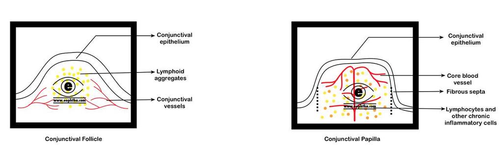 Conjunctiva sejtes beszűrődése Folliculusképződés Alapszövetben