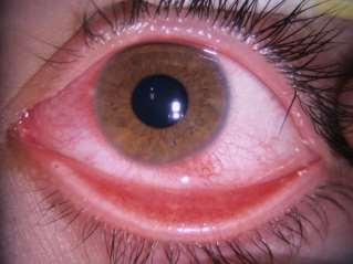 conjunctivitis Keratoconjunctivitis