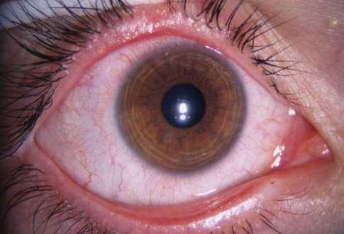 Conjunctivitis vernalis 5-10 éves fiúk, utána fiúk-lányok;