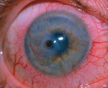 descemetocele Gyakran társul: scleritis, episcleritis Mooren