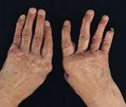 Rheumatoid