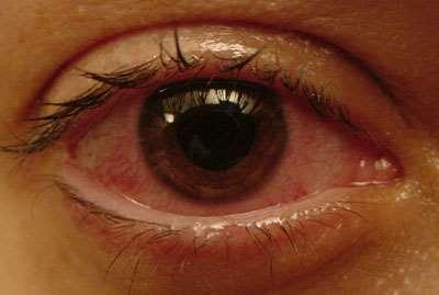 szem gyulladásos betegségei