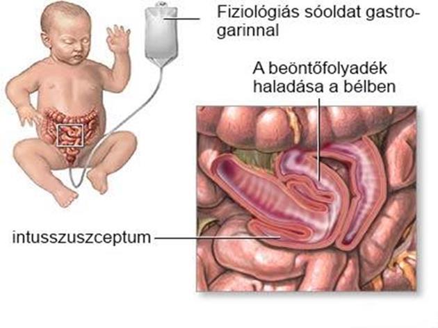 10. ábra A hidrosztatikus desinvaginatio menete A test síkja fölé maximum 100 cm-re helyezzük a folyadékot tartalmazó tartályt.