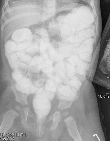 11.ábra AP irányú hasi röntgen felvétel, desinvaginatio után feltöltött vastagbél, az invaginatio megszűnt a kontrasztanyag a vékonybélbe jutott Sikeres beöntéses desinvagináció kritériumai: 1.