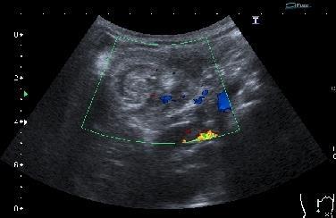 14.ábra 2D UH Color Doppler keresztmetszeti kép céltábla jel az invaginatio látható 15.