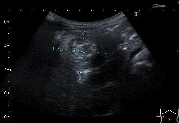 megfelelő pseudokidney látható. A terminalis ileum kb 8,5 cm hosszan a coecumba és a colon ascendensbe invaginalódott.