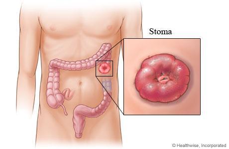 Enterostomák Enterostomák formái Stoma: száj, szájadék, nyílás Olyan a testfelszínen kialakított nyílás, amelynek szerepe az adott betegség, állapot esetén bizonyos,- az élethez elengedhetetlenül