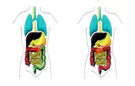 Colostoma Transversum colostoma indikációja: Mélyebben fekvő bélszakasz betegsége. Inoperábilis tumor miatt nem átjárható a bél. Bélresekció után anastomosis védelme.
