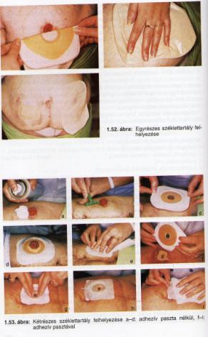Ápolási dokumentáció Jelölje: a stoma és a bőr állapotát a széklet mennyiségét, minőségét, konzisztenciáját, színét a stoma típusát, valamint a felhasznált segédeszközök típusát.