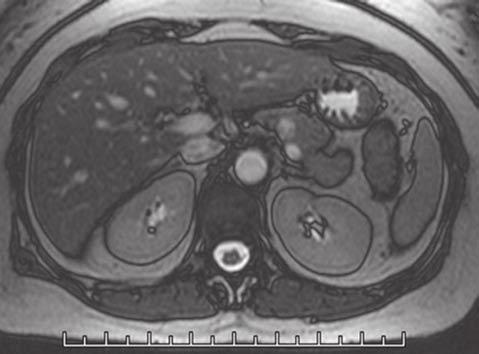 A pancreasból kiinduló neuroendokrin tumorok és exokrin malignus daganatok elkülönítése fontos, mert kezelésük (műtét, kemoterápia, egyéb gyógyszeres kezelés, sugárzó