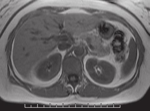 Esetismertetés A 49 éves nőbetegnél hasi ultrahangvizsgálat során, a hasnyálmirigy corpusában egy 12 mm-es, kerekded, jól határolt, a környező állománytól alig