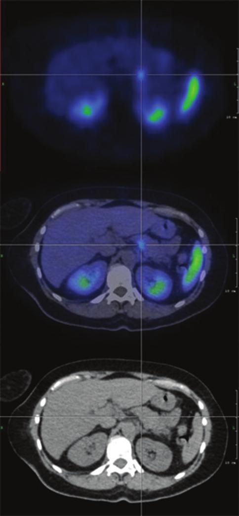 a) b) 5. ábra. a)-b) Szomatosztatinreceptor-szcintigráfia (SPECT/CT) történt, Tekrotyd Tc-99m radiofarmakon alkalmazásával.