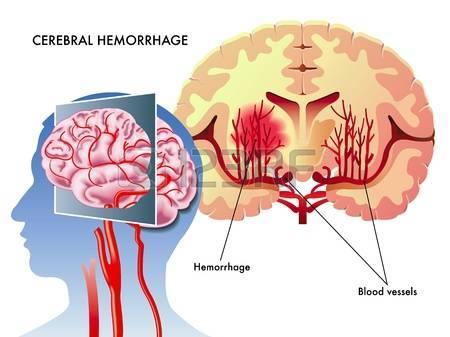 A vérzéses stroke sürgősségi vonatkozásai Dr.