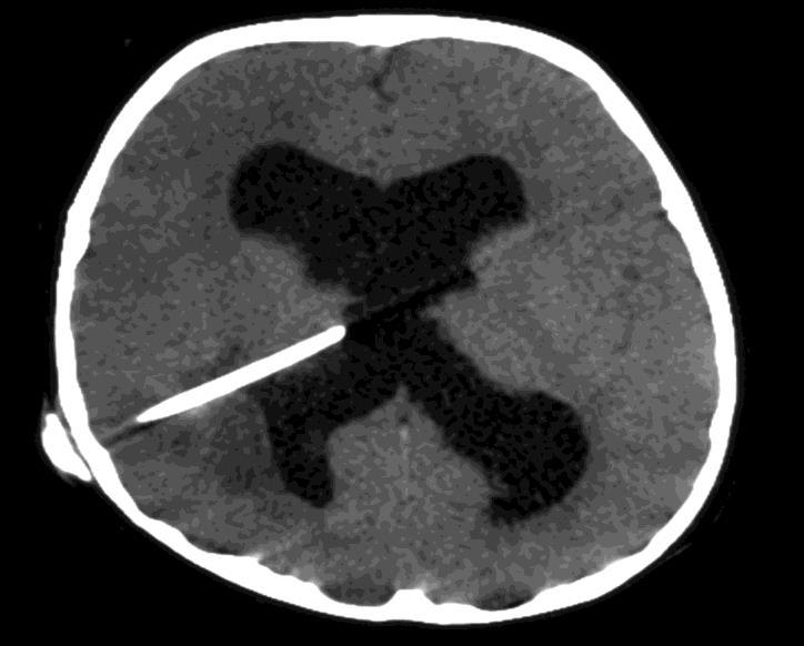 HYDROCEPHALUS Hydrocephalus esetén kamradrén behelyezése indokolt, különösen eszméletlen beteg esetén.
