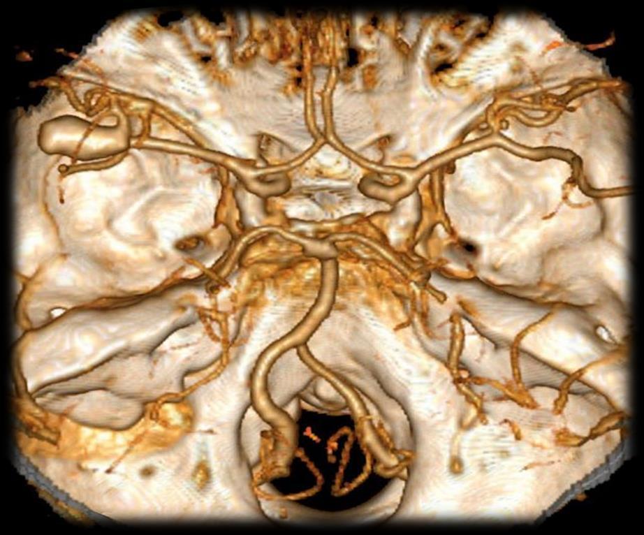 ETIOLÓGIA Aneurysma ruptúra 85%