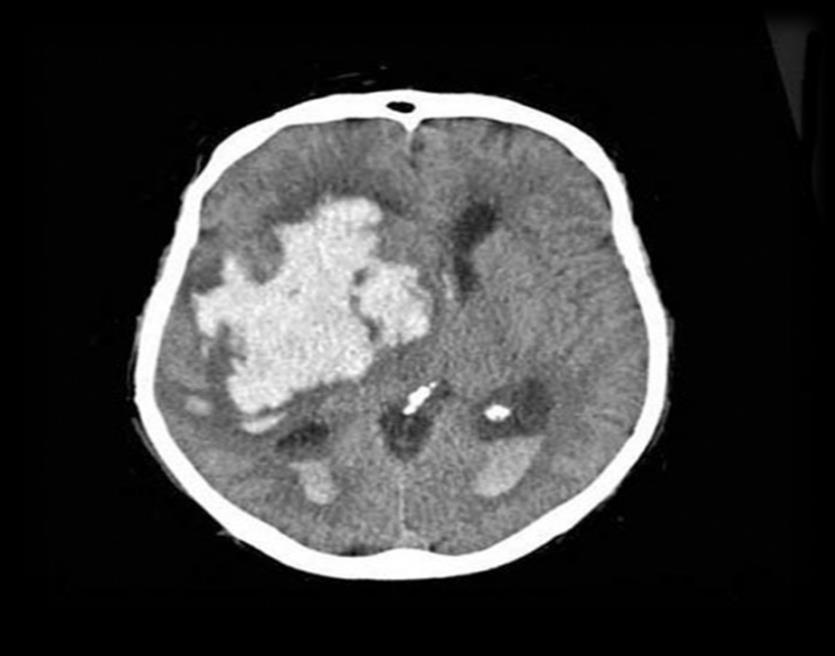 A VÉRZÉSES STROKE LEGGYAKORIBB ALCSOPORTJAI: 1. Intracerebralis haematoma (10-17%), 2.