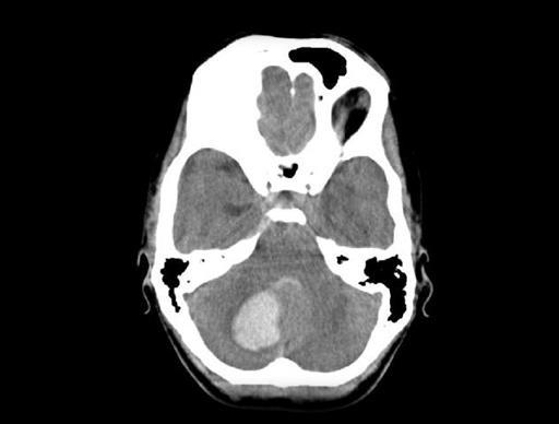 (striatocapsularis: 60%, thalamus: