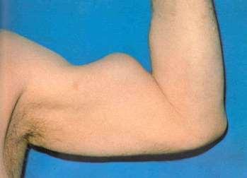 A m. biceps brachii ín