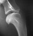 Ínbetegségek M. Biceps brachii elváltozásai Részleges-teljes szakadás A proc.