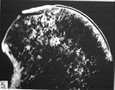 Osteochondrosis