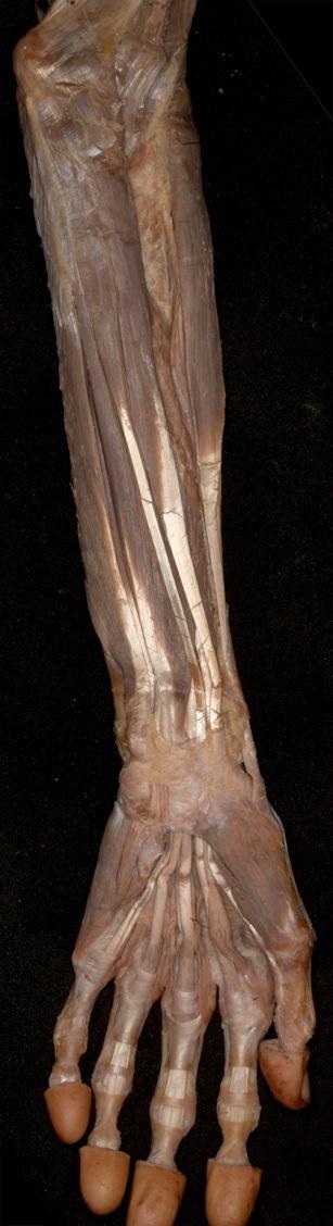 a bal könyökízület artrózisa 1 fok