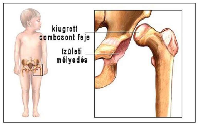 A fel nem ismert ficam később súlyos mozgászavart, az ízületet alkotók korai kopását, sérülését okozza az érintettekben.