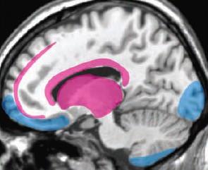 A sérülés a keresztmetszeti képen (6. ábra) a corpus callosum, az agykamrák környéke, valamint a homloklebenyben a szürke és fehér állomány összeköttetése területén jelentkezik. A kisagy alig sérül.