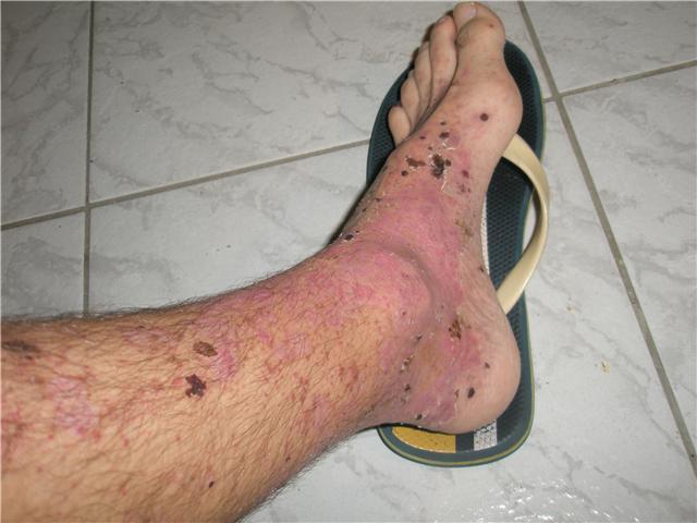 vasculitis kezelése 25. ábra.