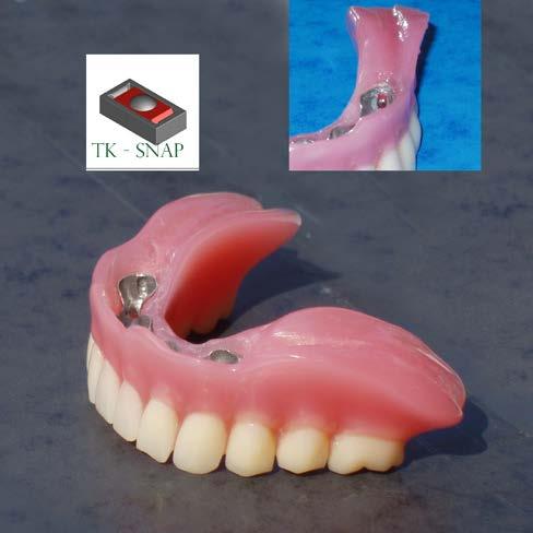 szájban is. Erre példa az alábbi három eset. 2016 végén a páciens azzal a kéréssel jelent meg a rendelésen, hogy készítsünk új pótlást az elkoptatott régi helyett.