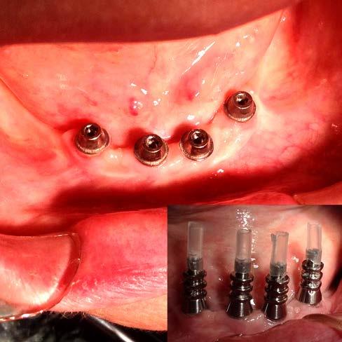 Nem az implantátumokról vettem a lenyomatot, hanem a transmukosális elemekről (balance base abutments), így a jól maturált és egészséges csont-gingiva határterületet sem kellett megbolygatni (4.