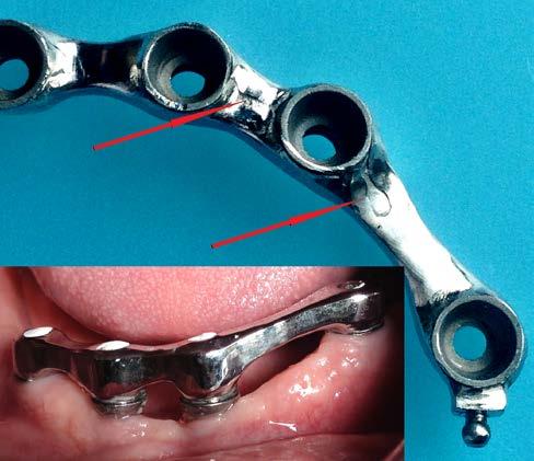 A beültetést követő ötödik héten, a 3.4-3.5-ös területére behelyezett implantátum felett gyulladásos reakció, duzzanat és nyomásérzékenység jelentkezett. A nyálkahártyára rámetszve pus ürült.