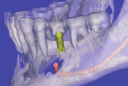 AZ IMPLANTÁTUMOK SZÁMÍTÓGÉPES ELHELYEZÉSE 12 A 3D kidolgozási lehetőségekből kifolyólag, az implantációt megelőző diagnosztika már háromdimenziós képekre alapozhat, melyek az emberi test hű mását