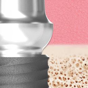 Cortical level Műtéti tapasztalatok hosszú távon azt bizonyítják, hogy az implantátum bennmaradási esélyét lényegesen javítja ha a corticalis szintre illetve az alá ( 0,5-1 mm-re ) kerül behelyezésre