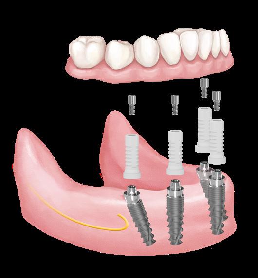 17 All-on-4 és All-on-6 előnyös megoldások All-on-4 a gazdaságos megoldás Az All-on-4 megoldással nagy stabilitás érhető el, mindössze négy implantátum beültetésével.