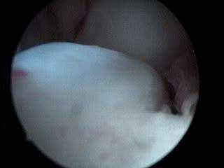 LCA A semitendinosus graft előnyei: tendocyták 60%-a mutat túlélést Johnson L., L. The outcome of a free autogenous semitendinosus tendon autograft in human anterior cruciate reconstructive surgery.