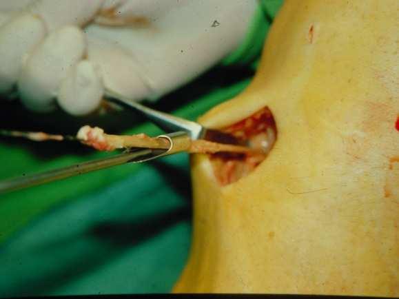 függıen) graft augmentációja neuromuscularis rendszer