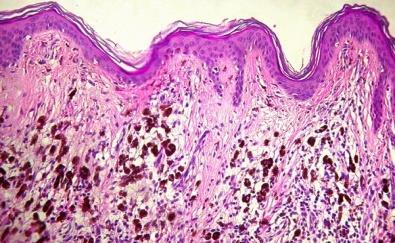 perineurális terjedés A tumor
