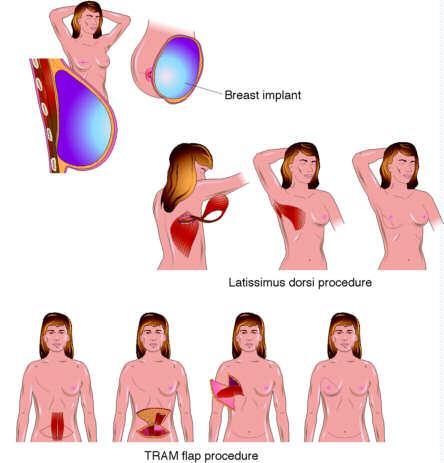 1. Primer Tumor 1.1. Csökkentett radikalitás Struktura Funkció Esztétikum 1.2. Komplex Terápia Sugárkezelés Kemotherapia Onkosebészet fejlődése I. 2. Metastasisok 2.1. Regionalis Metastasis Sentinel nyirokcsomó Block-disszekció 2.